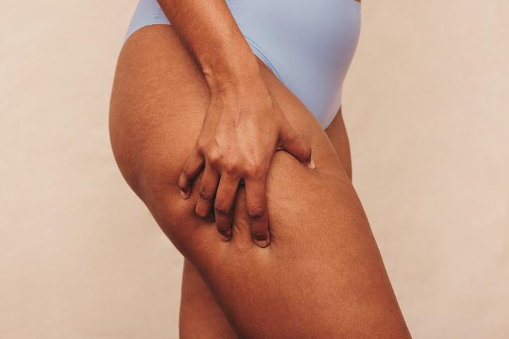 Is It Possible To Get Rid of Cellulite?