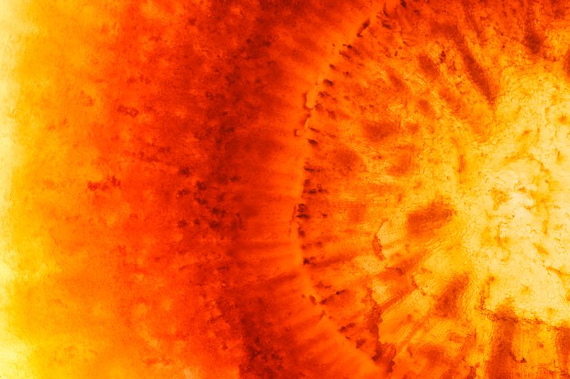 Эндометриоз — болезнь загадка